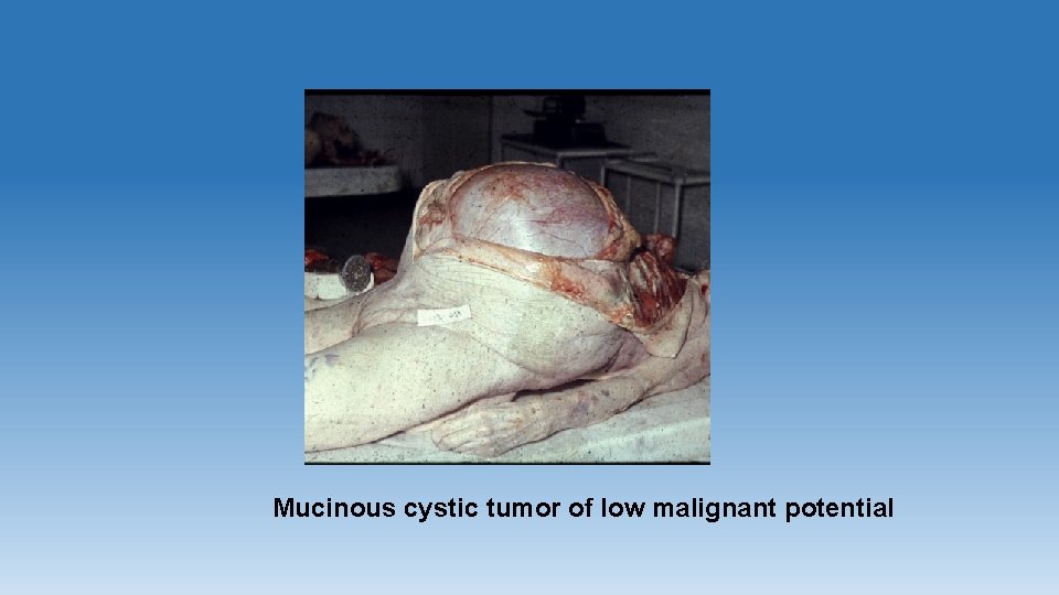 Mucinous cystic tumor of low malignant potential 