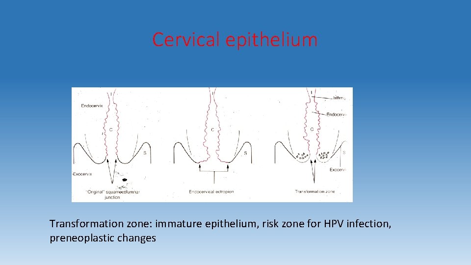 Cervical epithelium Transformation zone: immature epithelium, risk zone for HPV infection, preneoplastic changes 