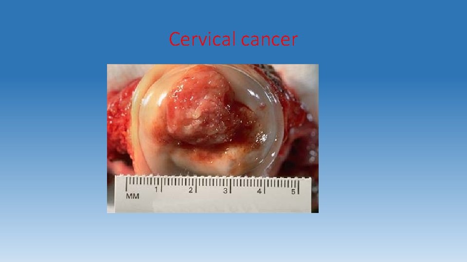 Cervical cancer 