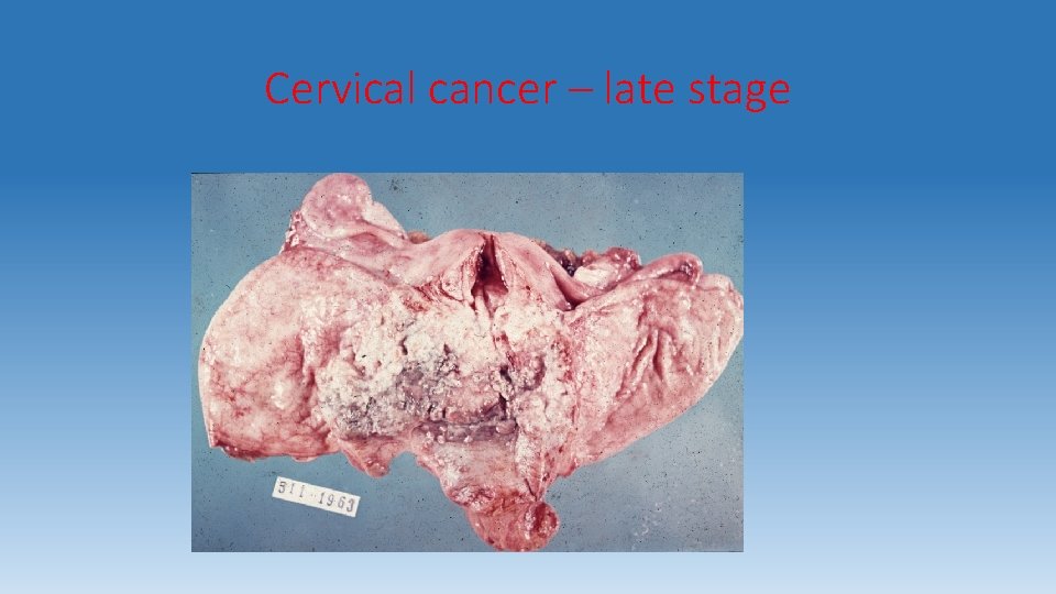 Cervical cancer – late stage 