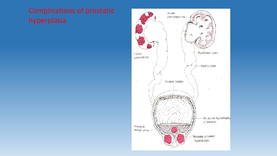 Complications of prostatic hyperplasia 