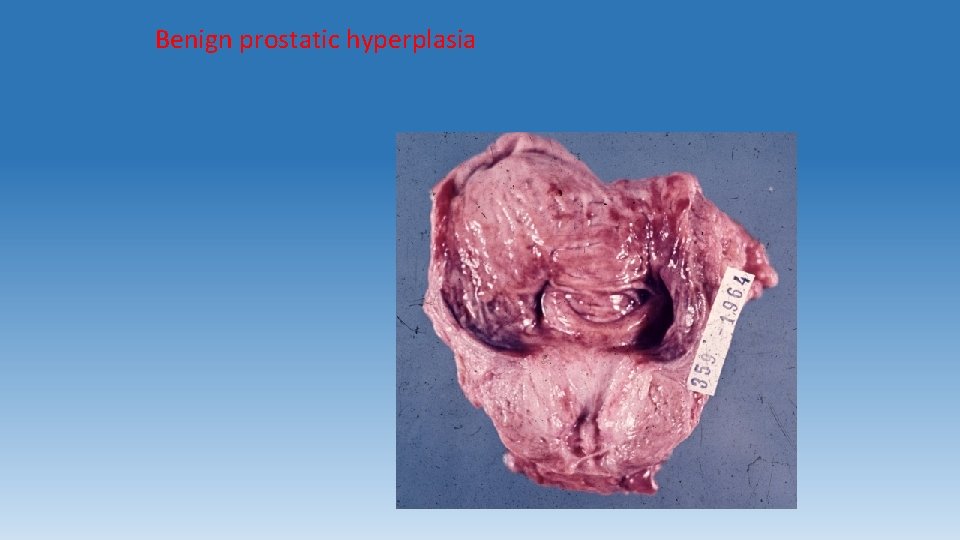 Benign prostatic hyperplasia 
