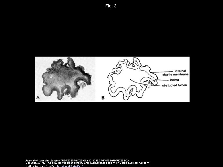 Fig. 3 Journal of Vascular Surgery 1994 20607 -612 DOI: (10. 1016/0741 -5214(94)90285 -2)