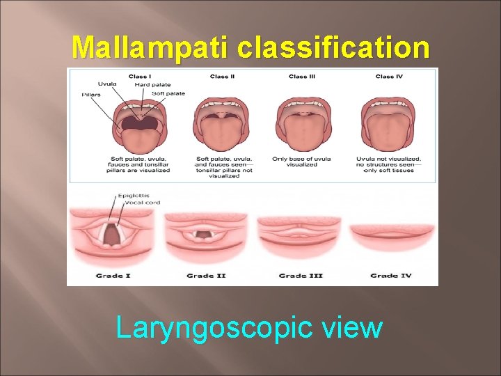 Mallampati classification Laryngoscopic view 