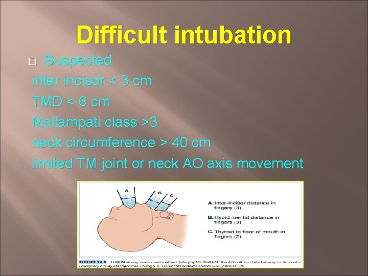 Difficult intubation Suspected inter incisor < 3 cm TMD < 6 cm Mallampati class