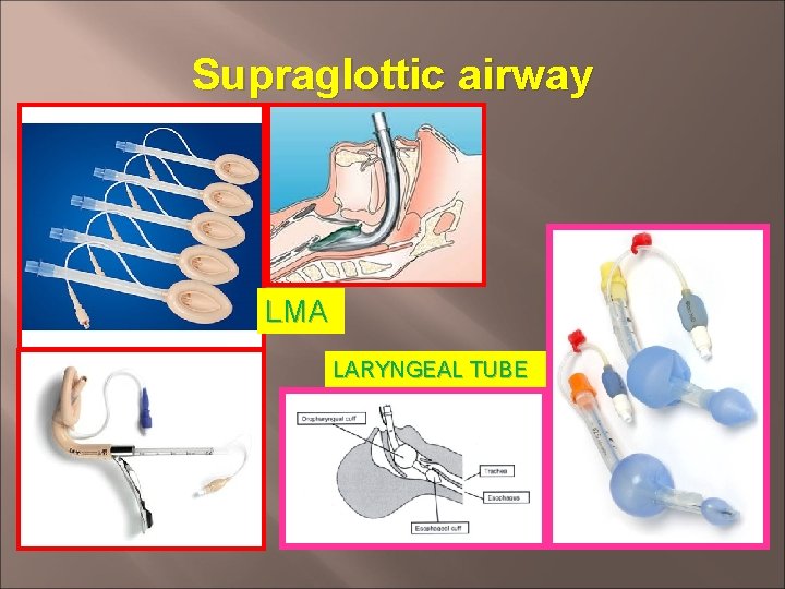 Supraglottic airway LMA LARYNGEAL TUBE 