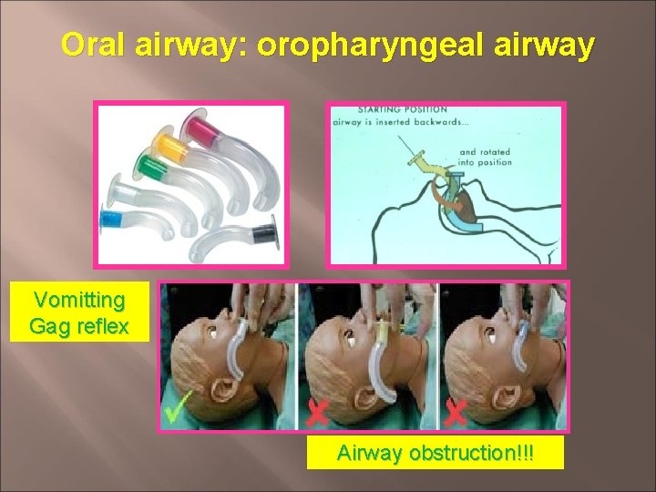 Oral airway: oropharyngeal airway Vomitting Gag reflex Airway obstruction!!! 