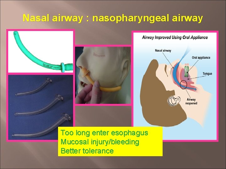 Nasal airway : nasopharyngeal airway Too long enter esophagus Mucosal injury/bleeding Better tolerance 