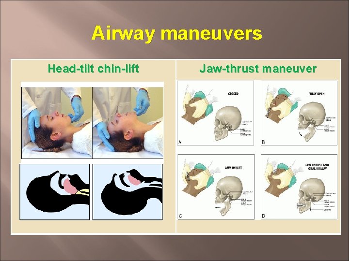 Airway maneuvers Head-tilt chin-lift Jaw-thrust maneuver Airway maneuvers Head-tilt chin-lift Jaw-thrust maneuver
