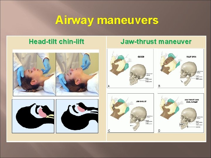 Airway maneuvers Head-tilt chin-lift Jaw-thrust maneuver 