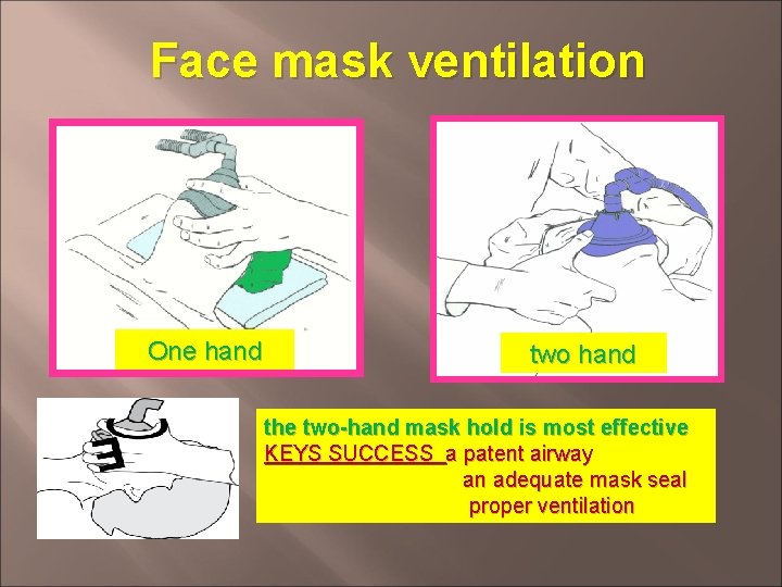 Face mask ventilation One hand two hand the two-hand mask hold is most effective