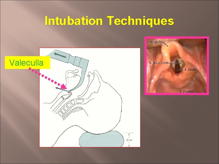 Intubation Techniques Valeculla 