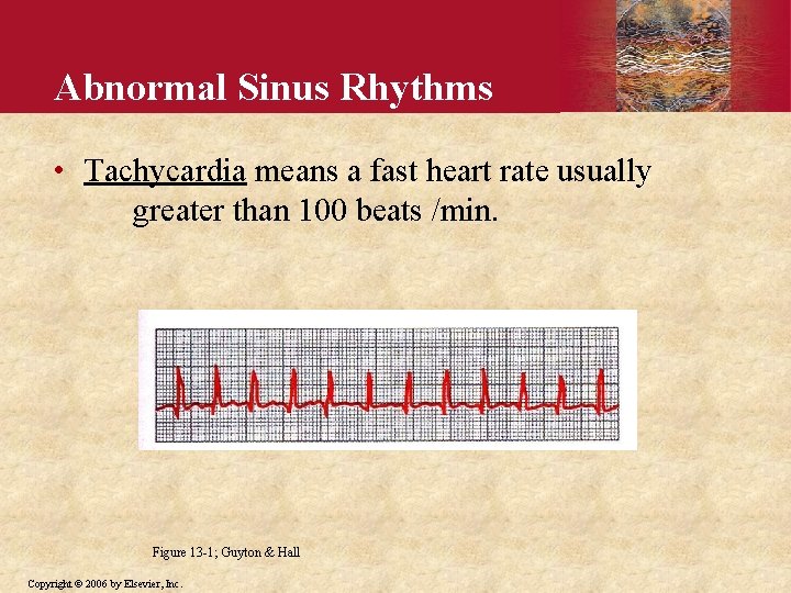 Abnormal Sinus Rhythms • Tachycardia means a fast heart rate usually greater than 100