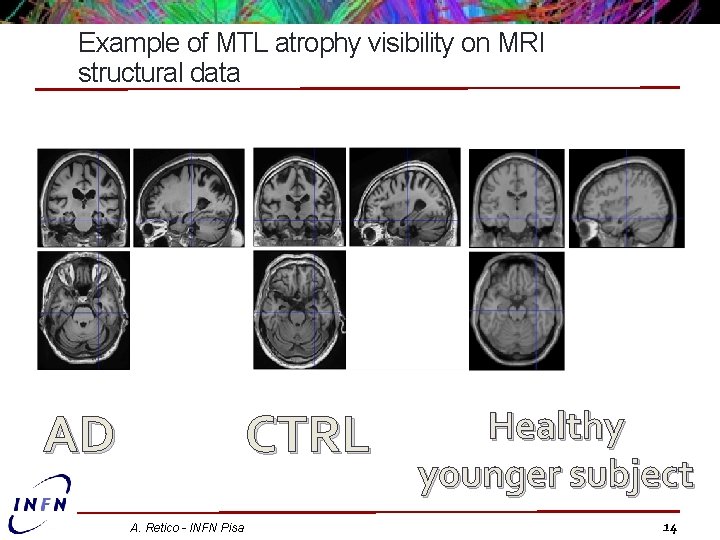 Example of MTL atrophy visibility on MRI structural data AD CTRL A. Retico -