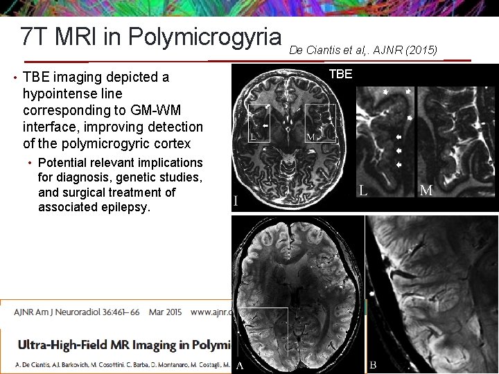 7 T MRI in Polymicrogyria De Ciantis et al, . AJNR (2015) • TBE