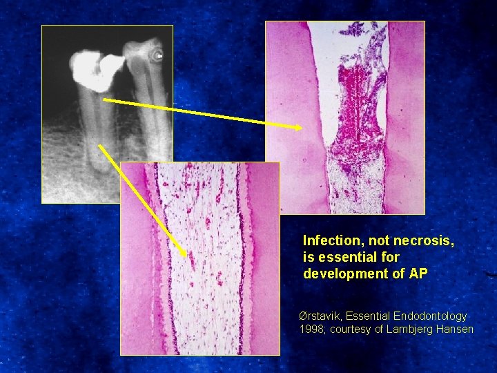 Infection, not necrosis, is essential for development of AP Ørstavik, Essential Endodontology 1998; courtesy