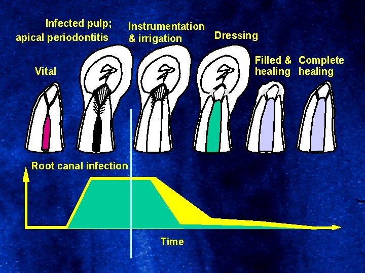 Infected pulp; apical periodontitis Instrumentation Dressing & irrigation Filled & Complete healing Vital Root