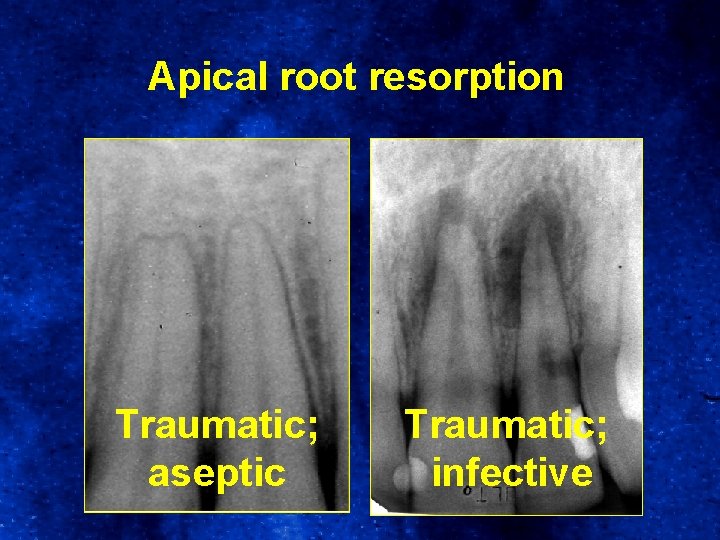 Apical root resorption Traumatic; aseptic Traumatic; infective 