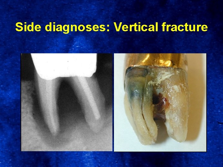 Side diagnoses: Vertical fracture 