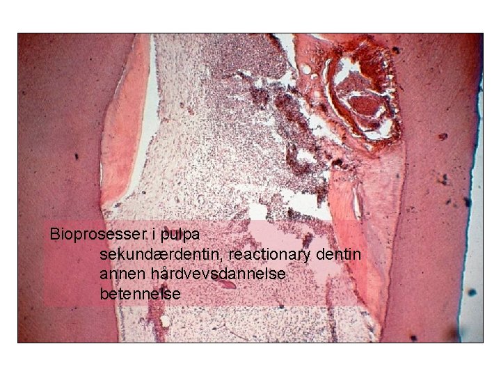 Bioprosesser i pulpa sekundærdentin, reactionary dentin annen hårdvevsdannelse betennelse 
