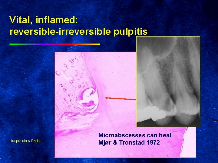 Vital, inflamed: reversible-irreversible pulpitis Haapasalo & Endal Microabscesses can heal Mjør & Tronstad 1972
