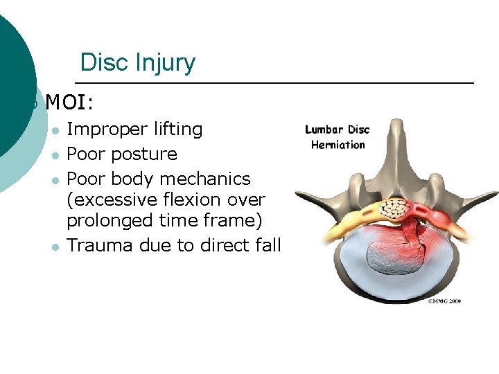 Disc Injury ¡ MOI: l l Improper lifting Poor posture Poor body mechanics (excessive