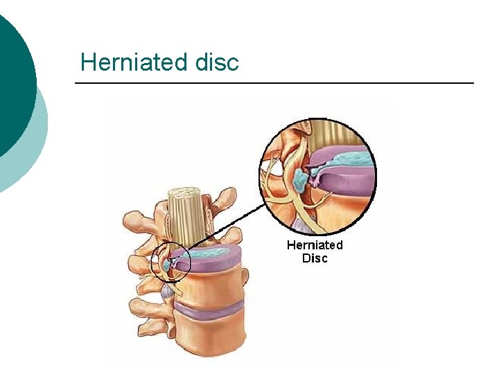 Herniated disc 