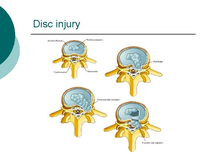 Disc injury 