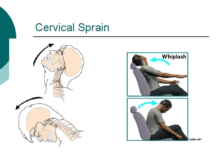 Cervical Sprain 