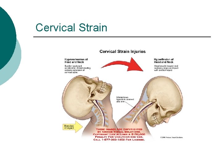 Cervical Strain 