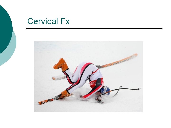 Cervical Fx 