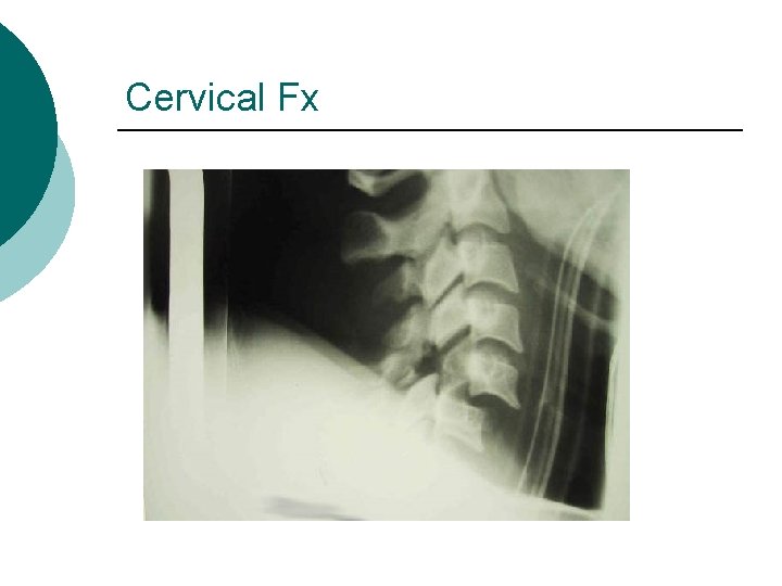 Cervical Fx 