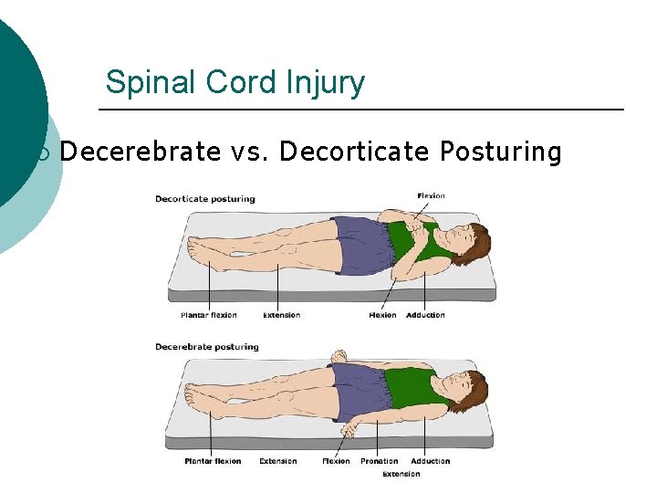 Spinal Cord Injury ¡ Decerebrate vs. Decorticate Posturing 