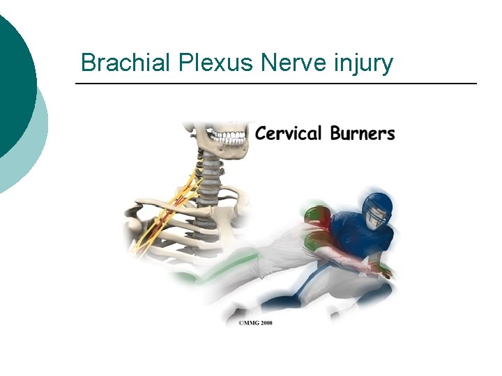 Brachial Plexus Nerve injury 