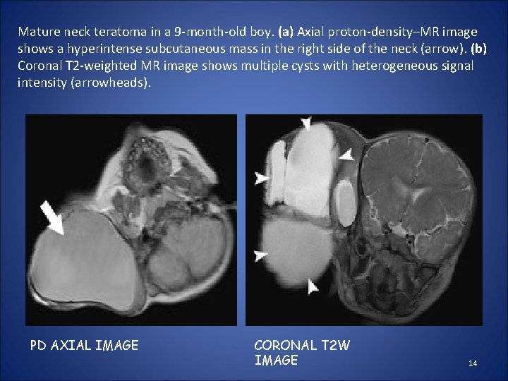 Mature neck teratoma in a 9 -month-old boy. (a) Axial proton-density–MR image shows a