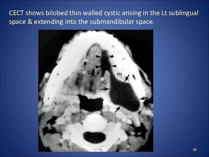 CECT shows bilobed thin walled cystic arising in the Lt sublingual space & extending