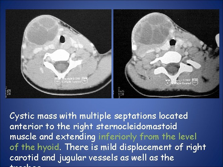 Cystic mass with multiple septations located anterior to the right sternocleidomastoid muscle and extending