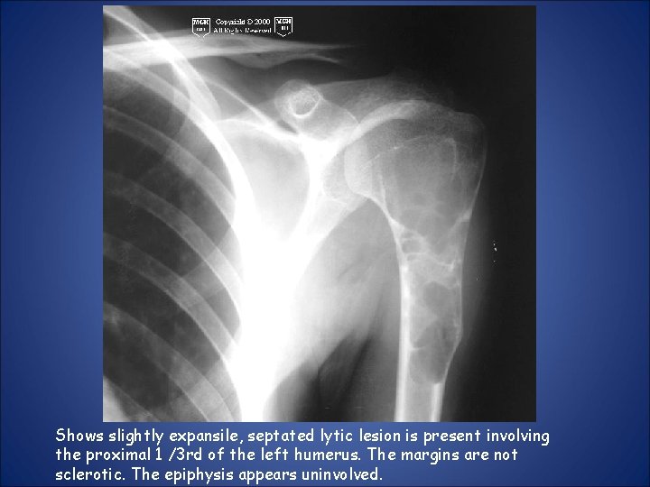 Shows slightly expansile, septated lytic lesion is present involving the proximal 1 /3 rd