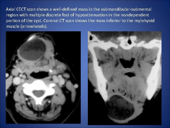 Axial CECT scan shows a well-defined mass in the submandibular-submental region with multiple discrete