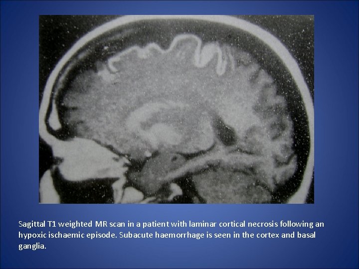 Sagittal T 1 weighted MR scan in a patient with laminar cortical necrosis following