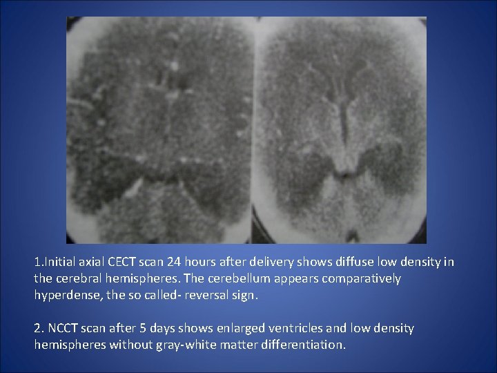 1. Initial axial CECT scan 24 hours after delivery shows diffuse low density in