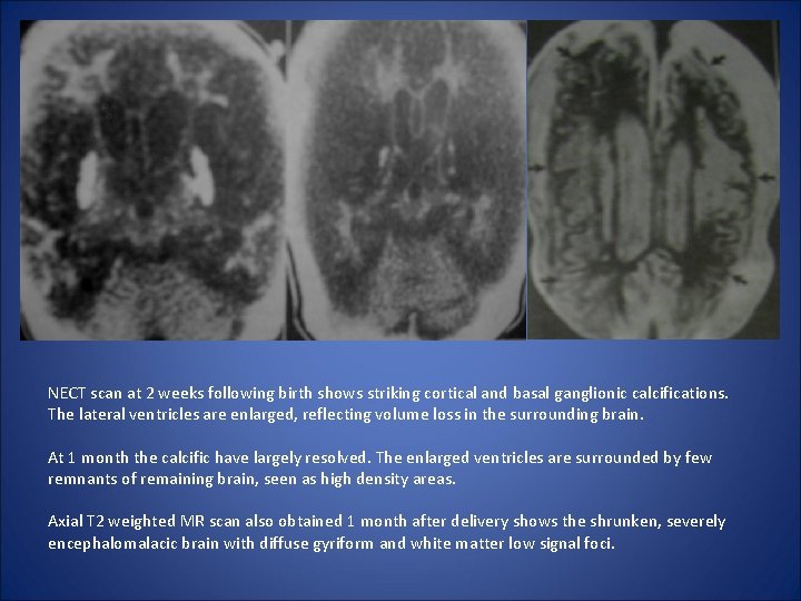 NECT scan at 2 weeks following birth shows striking cortical and basal ganglionic calcifications.