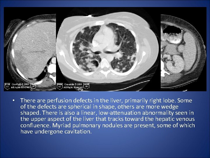  • There are perfusion defects in the liver, primarily right lobe. Some of