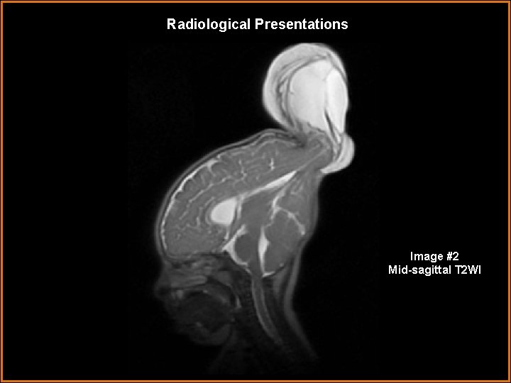 Radiological Presentations Image #2 Mid-sagittal T 2 WI 