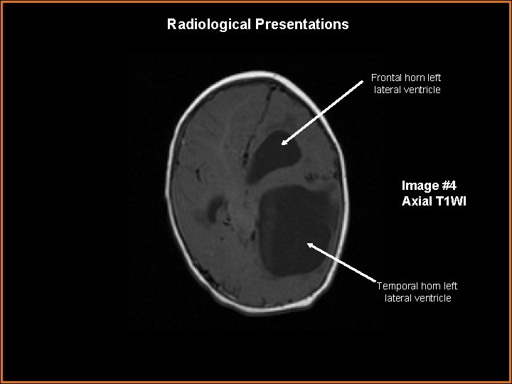 Radiological Presentations F Frontal horn left lateral ventricle Image #4 Axial T 1 WI