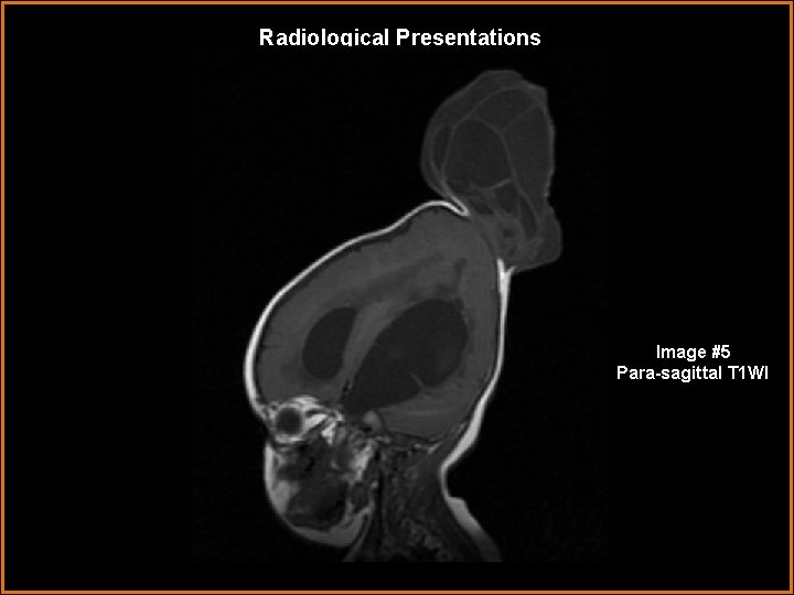 Radiological Presentations Image #5 Para-sagittal T 1 WI 