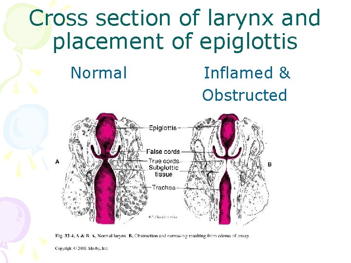 Cross section of larynx and placement of epiglottis Normal Inflamed & Obstructed 
