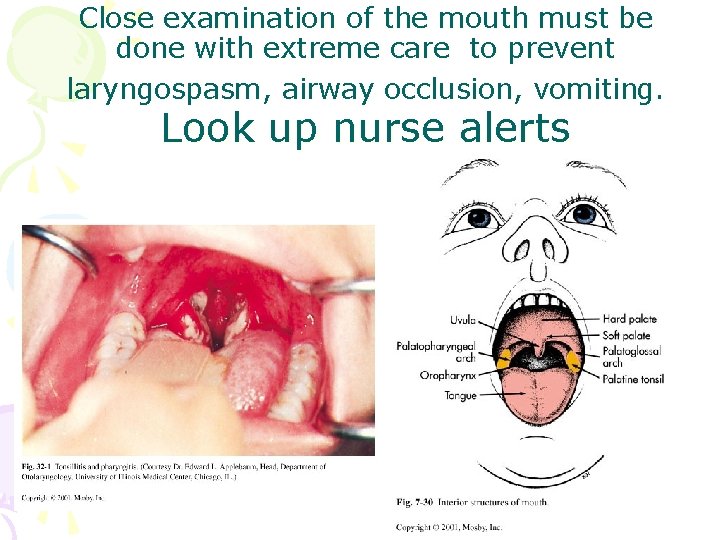 Close examination of the mouth must be done with extreme care to prevent laryngospasm,