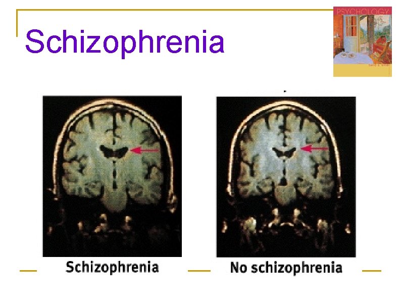 Schizophrenia Schizophrenia