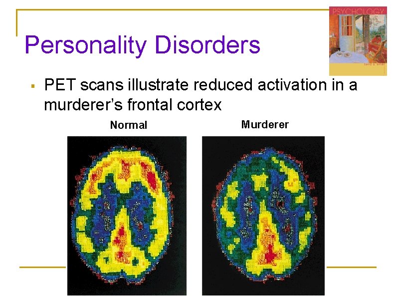 Personality Disorders § PET scans illustrate reduced activation in a murderer’s frontal cortex Normal Personality Disorders § PET scans illustrate reduced activation in a murderer’s frontal cortex Normal